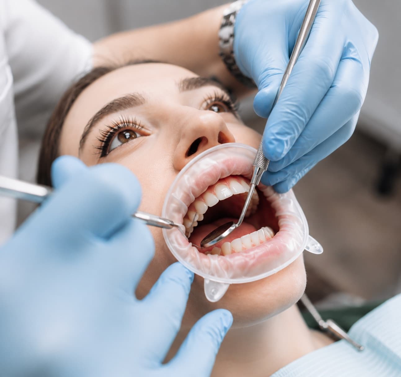 A dentist examining a patient's teeth with a mirror and probe, a cheek retractor holding the lips clear
