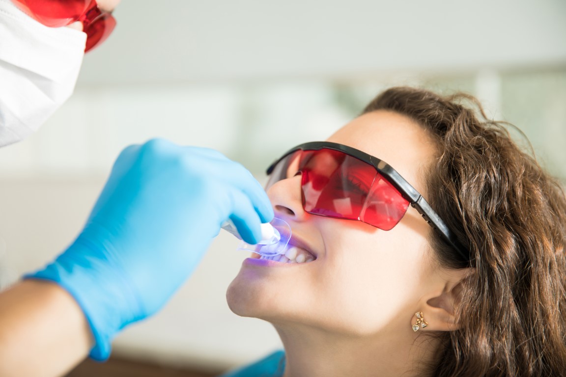 You are currently viewing Professional Teeth Whitening: Everything You Need to Know