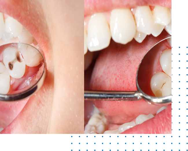 Composite Dental Fillings Near me Open Now