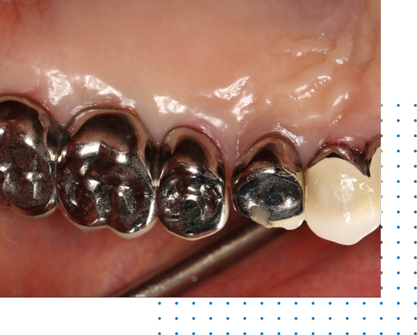 Cheap Full Mouth Reconstruction