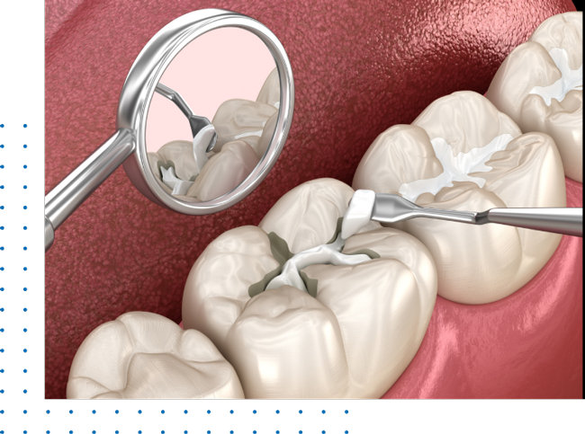 Los Angeles Ca Dental Fillings