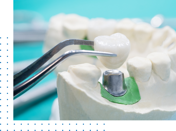 Dental Bridge Cost Los angeles