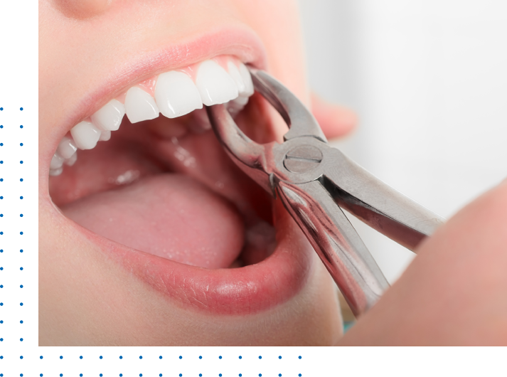 Cheap Wisdom Tooth Extraction Los Angeles