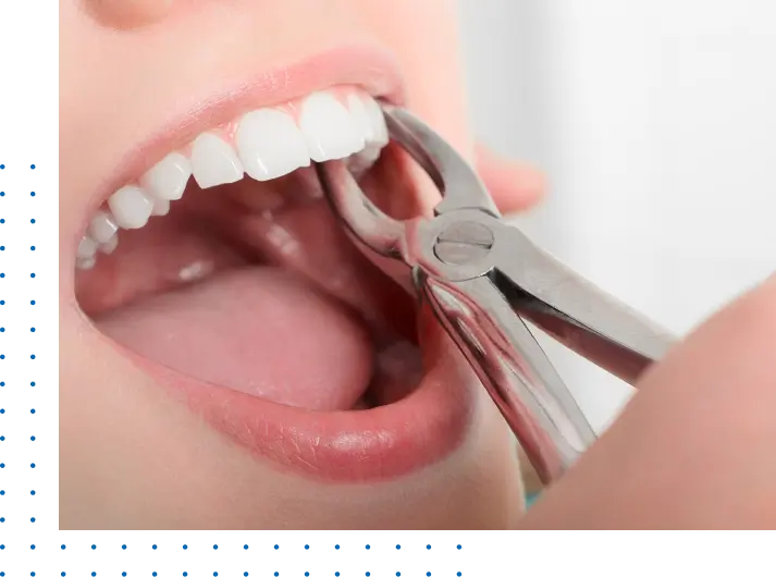 Cheap Wisdom Tooth Extraction Los Angeles