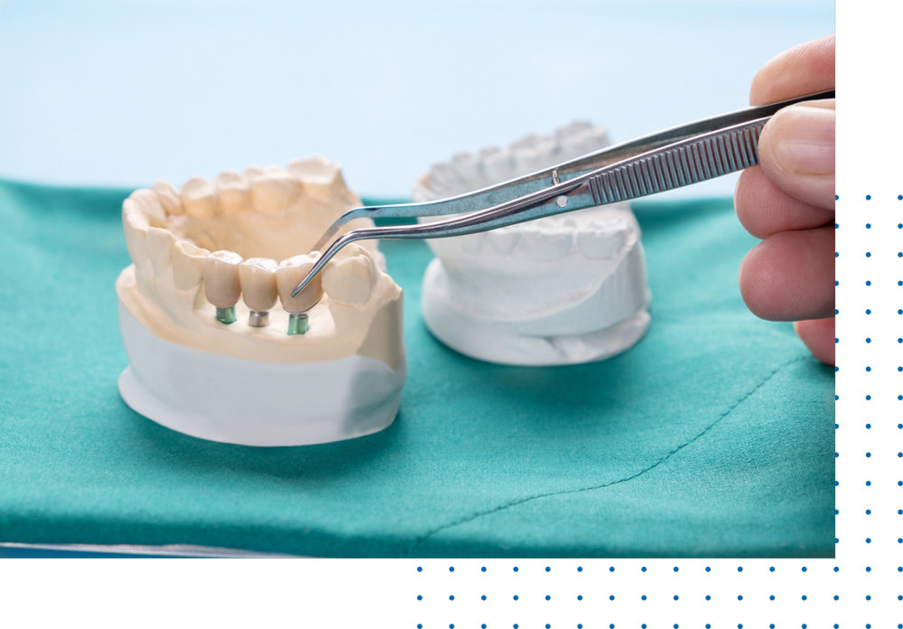Best Implant Retained Dentures in Los Angeles