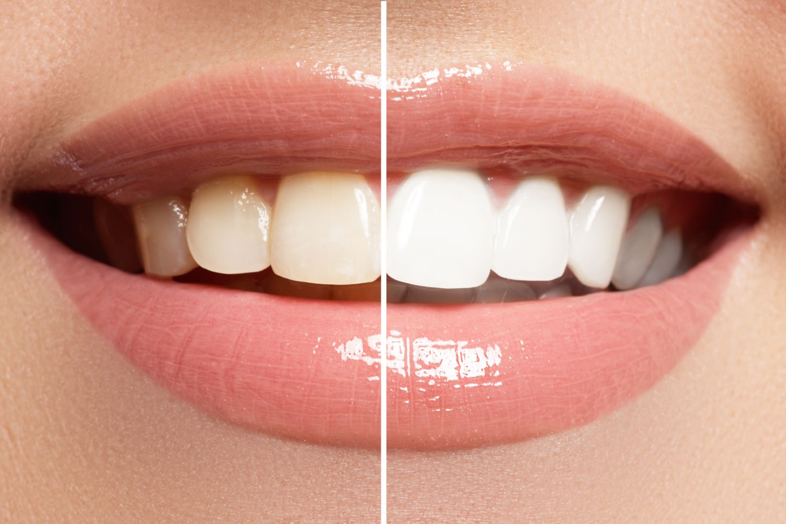 You are currently viewing Bananas and Teeth Whitening: Separating Fact From Fiction