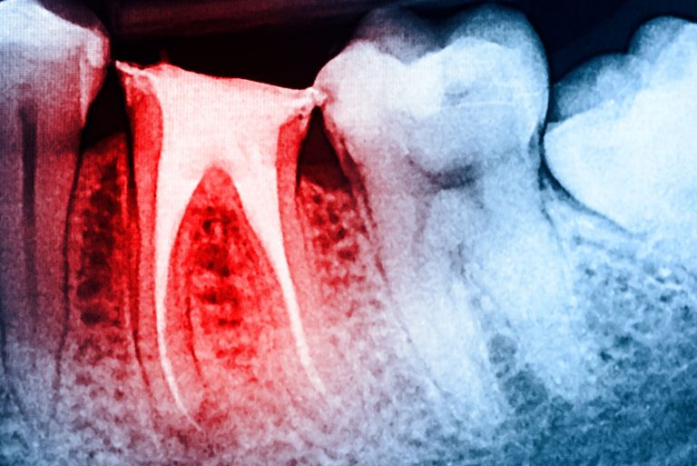 Read more about the article Sensitivity After A Root Canal: What’s Normal?