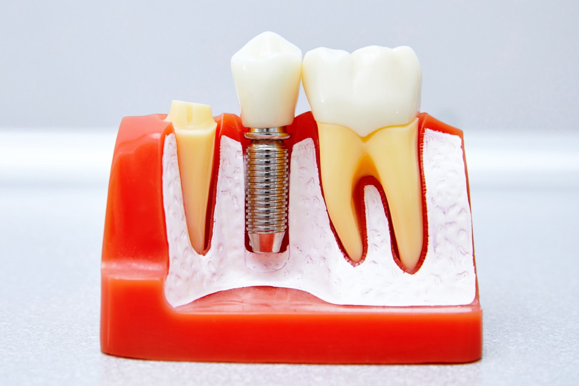 You are currently viewing How Do Dental Implants Work?