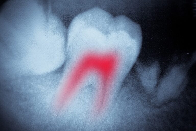 Read more about the article Common Root Canal Complications and How to Avoid Them