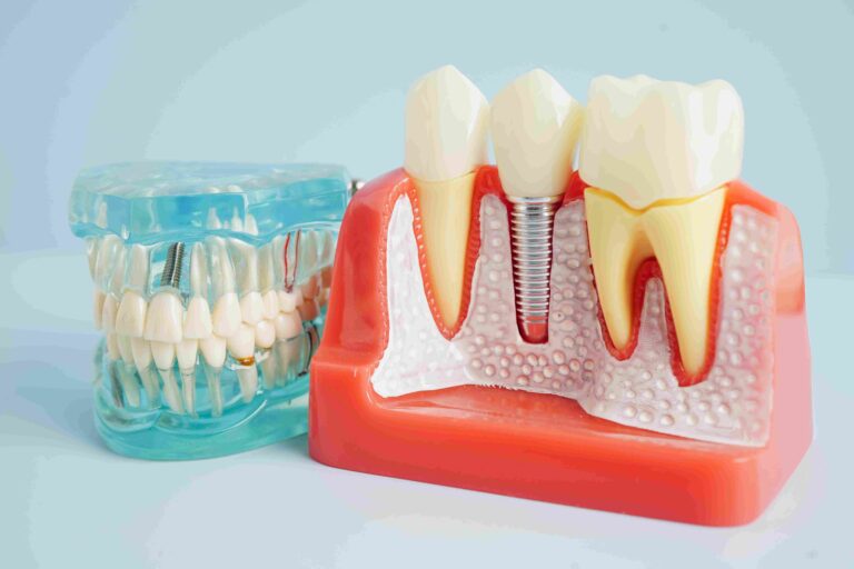 Read more about the article Am I a Candidate for Dental Implants?
