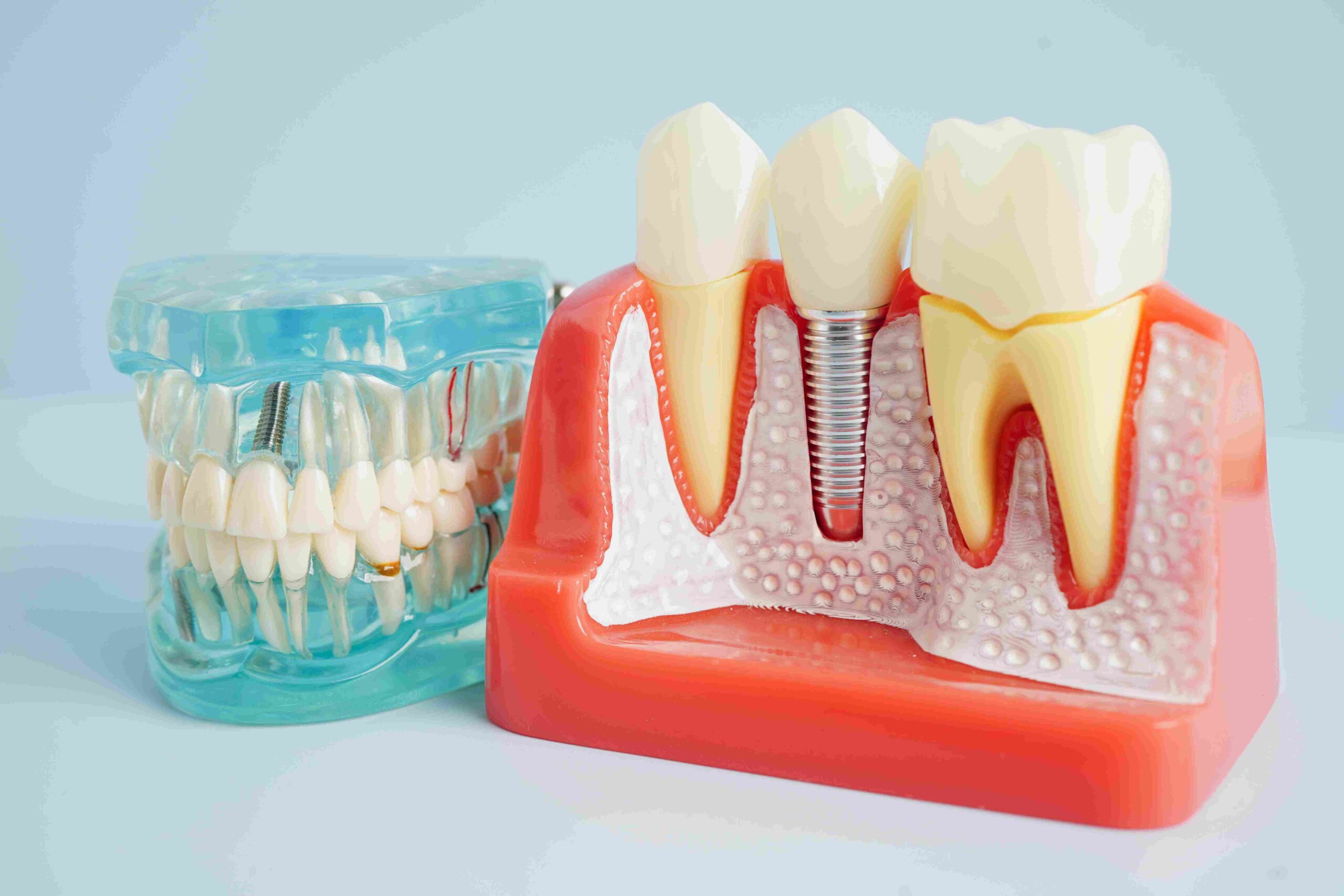 You are currently viewing Am I a Candidate for Dental Implants?